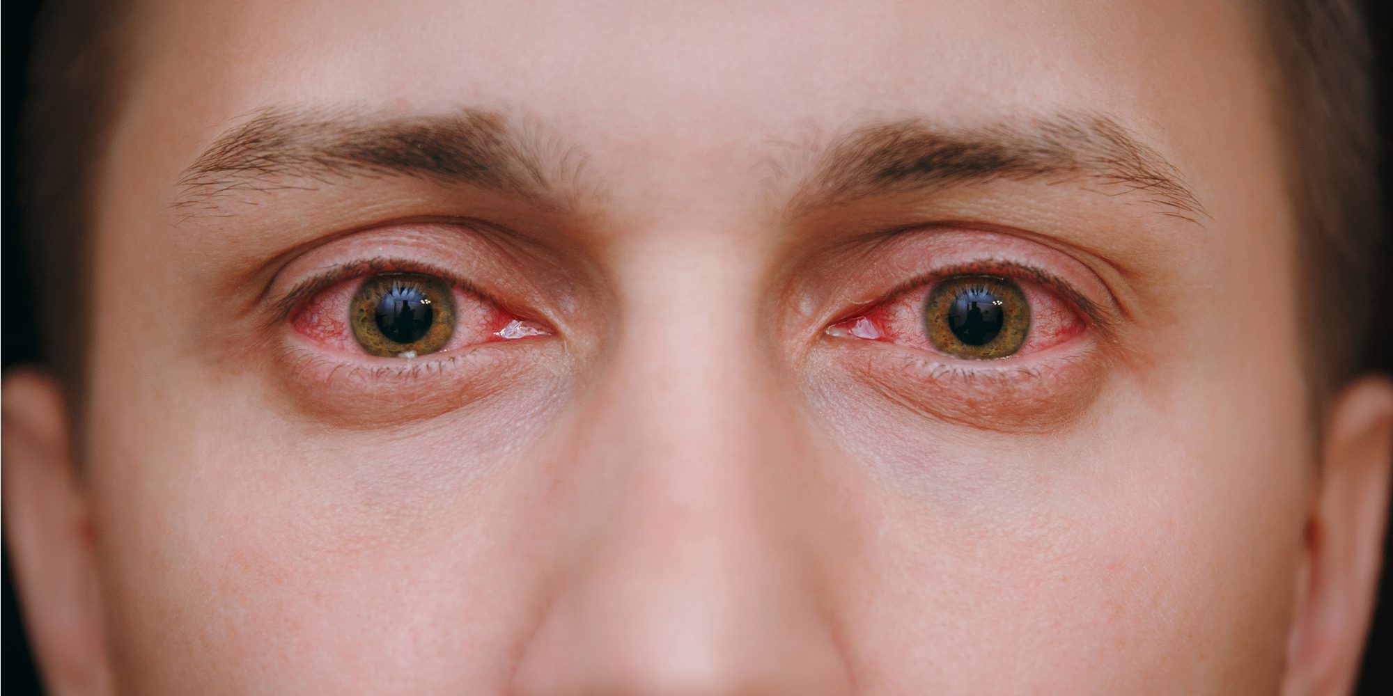 Red Eyes from Drinking