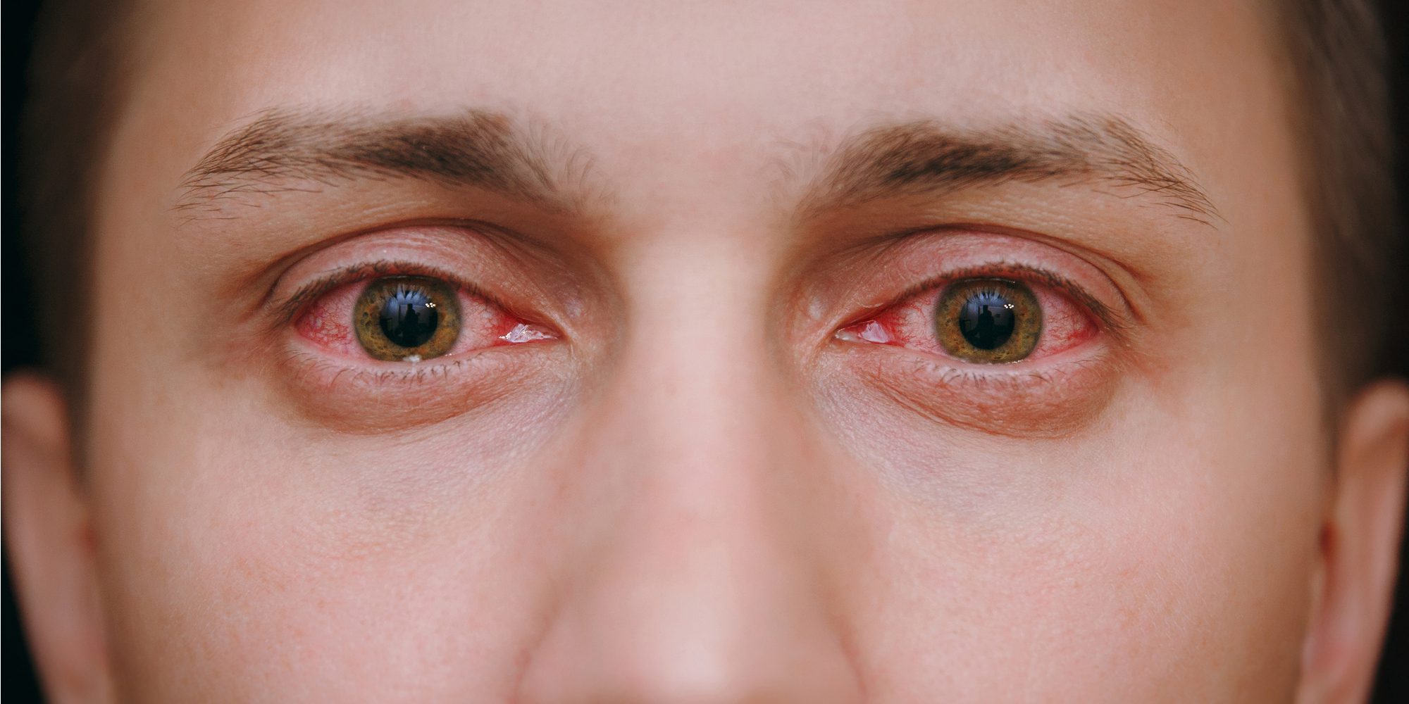 Can Alcohol Cause Red Eyes?